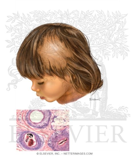 Trichotillomania