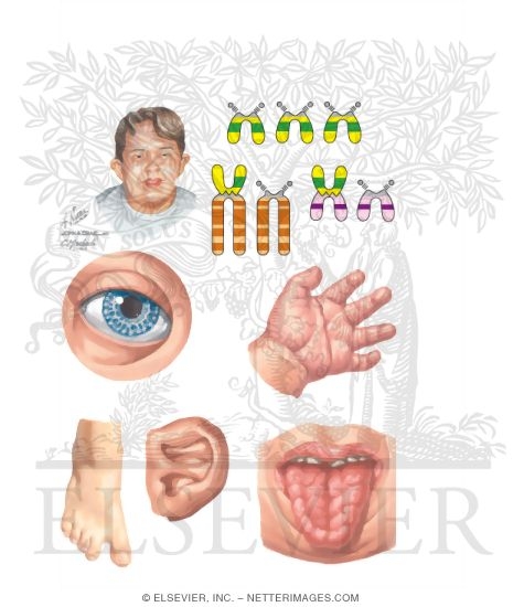 Watermarked preview of unlabeled image: Down Syndrome