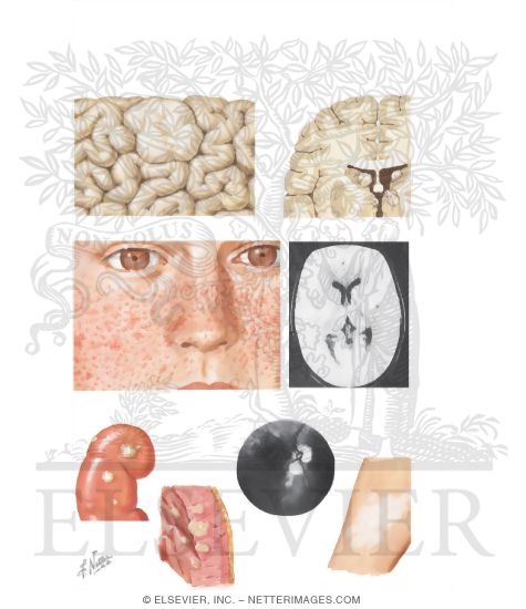Tuberous Sclerosis