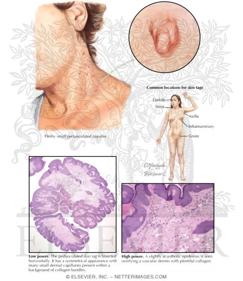 Acrochordon