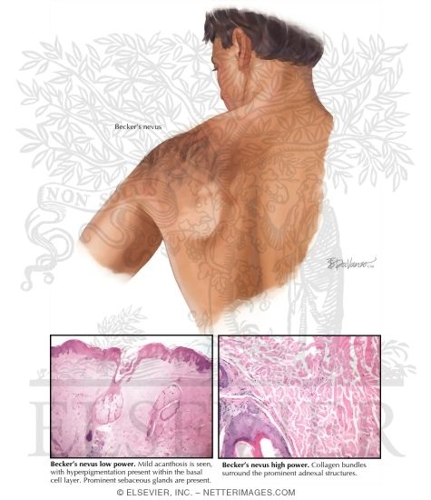 Becker's Nevus (Smooth Muscle Hamartoma)