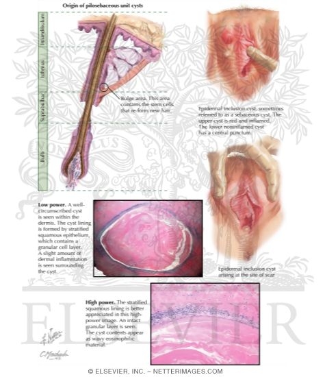 Epidermal Inclusion Cyst