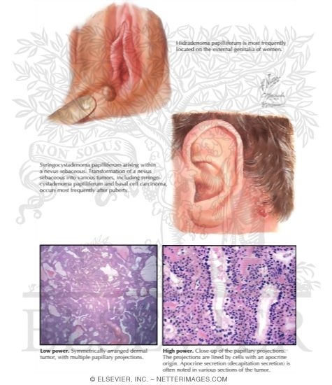 Watermarked preview of labeled image: Hidradenoma Papilliferum