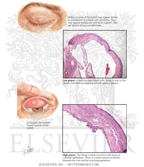 Watermarked preview of labeled image: Hidrocystoma