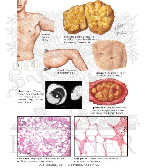 Lipoma