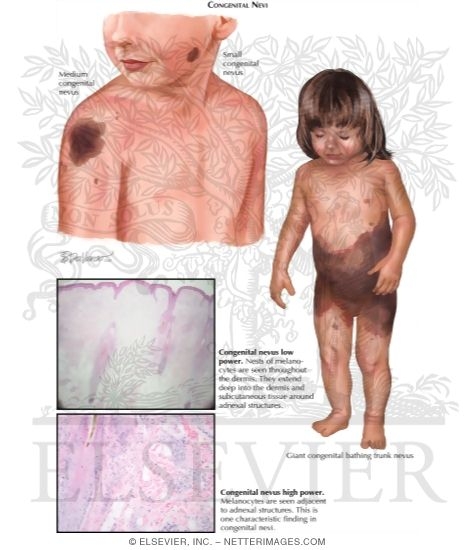 Watermarked preview of labeled image: Melanocytic Nevi (Continued)