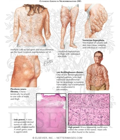 Neurofibroma