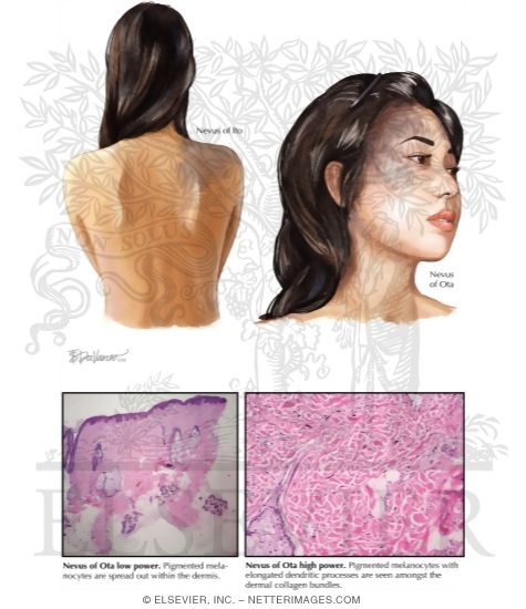 Nevus of Ota and Nevus of Ito