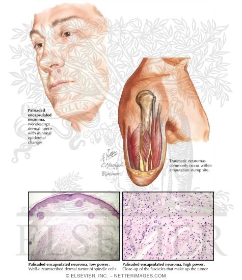 Palisaded Encapsulated Neuroma
