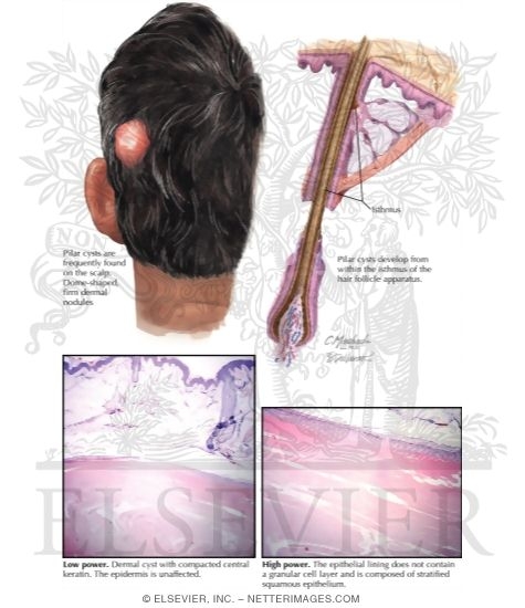 Pilar Cyst (Trichilemmal Cyst)