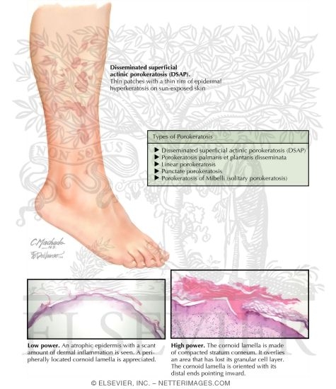 Porokeratosis