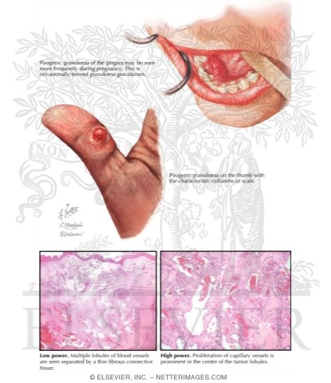 Watermarked preview of labeled image: Pyogenic Granuloma