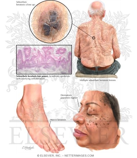 Seborrheic Keratosis