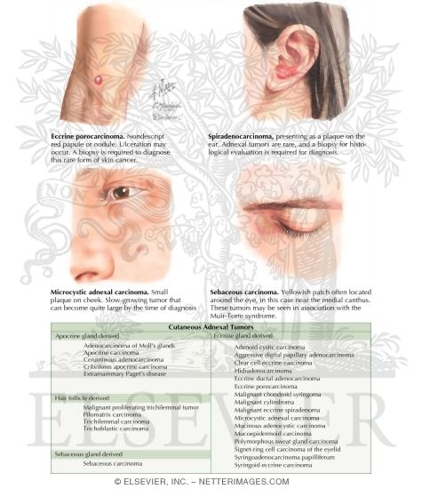 Adnexal Carcinomas