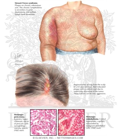 Angiosarcoma