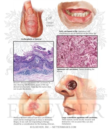 Bowen's Disease