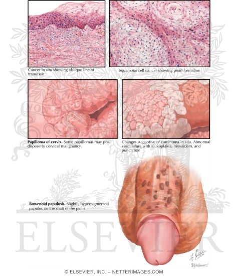 bowenoid papillomatosis