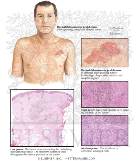 Dermatofibrosarcoma Protuberans