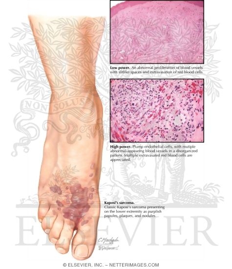 Kaposi's Sarcoma