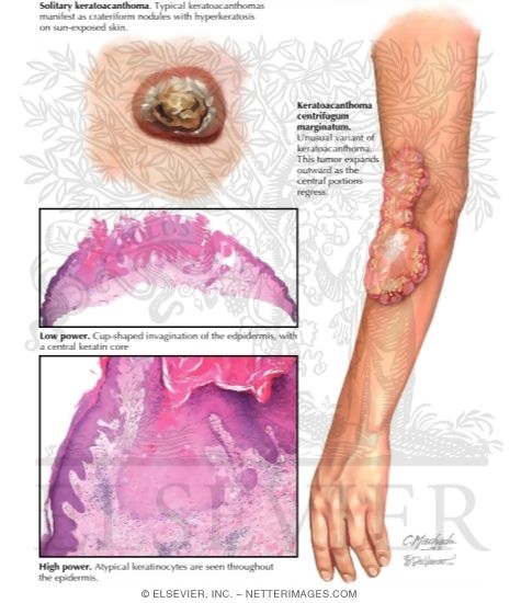 Keratoacanthoma