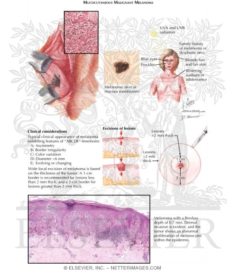 Melanoma