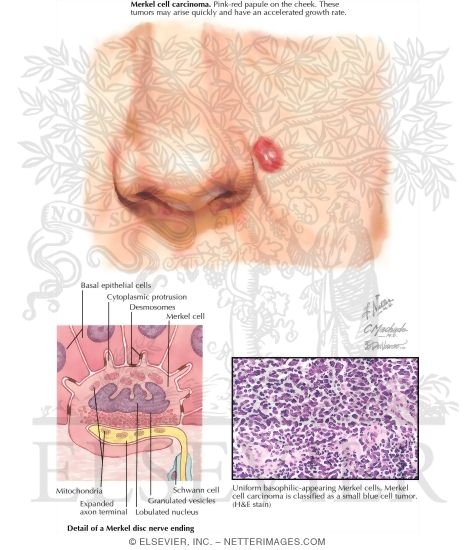Merkel Cell Carcinoma