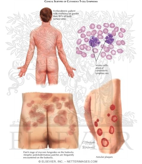 Mycosis Fungoides