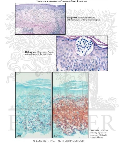 Mycosis Fungoides (Continued)