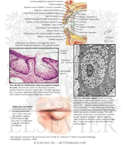 Sebaceous Carcinoma