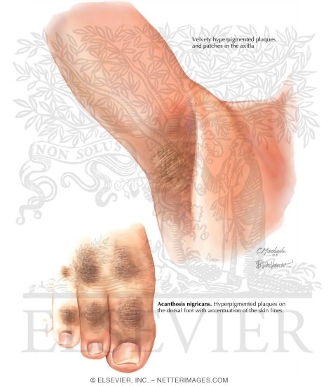 Acanthosis Nigricans