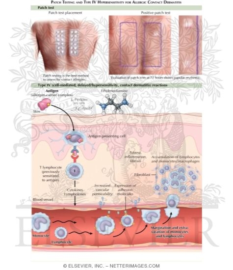 Allergic Contact Dermatitis (Continued)