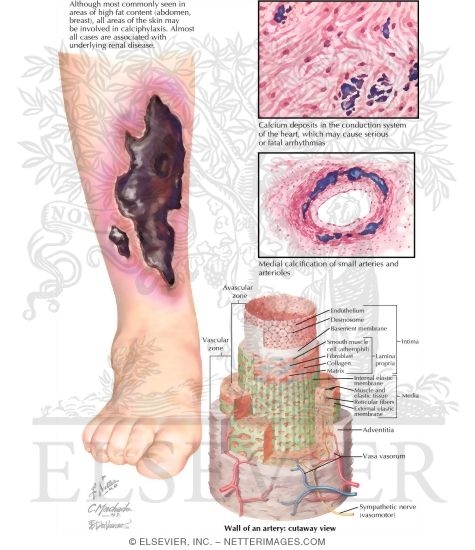 Watermarked preview of labeled image: Calciphylaxis