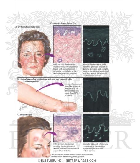 Cutaneous Lupus Band Test
