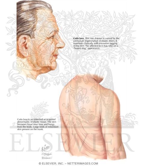 Cutis Laxa