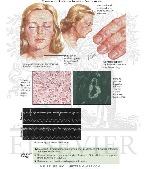 Watermarked preview of labeled image: Dermatomyositis and Polymyositis
