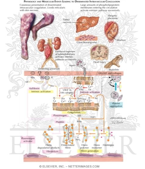 Disseminated Intravascular Coagulation