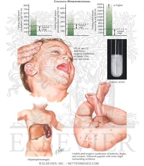 Watermarked preview of labeled image: Hypertriglyceridemia