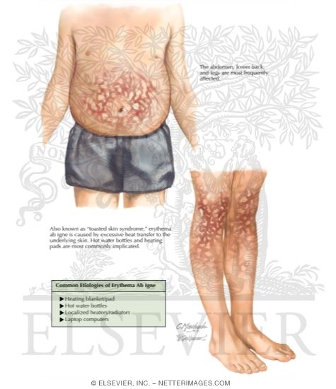Erythema store ab igne