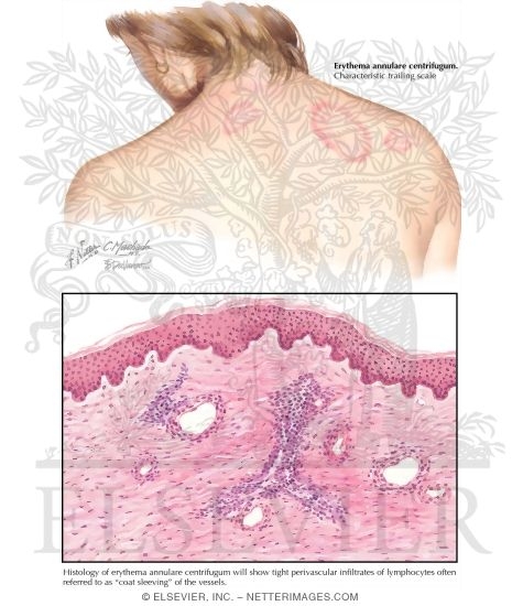 Erythema Annulare Centrifigum