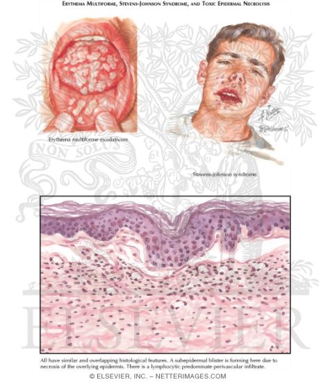Erythema Multiforme, Stevens-Johnson Syndrome, and Toxic Epridermal Necrolysis