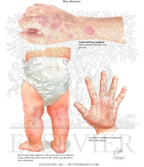 Erythema Multiforme, Stevens-Johnson Syndrome, and Toxic Epridermal Necrolysis (Continued)