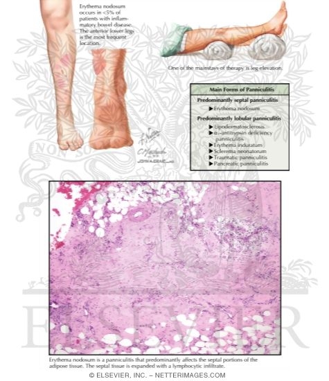 Erythema Nodosum