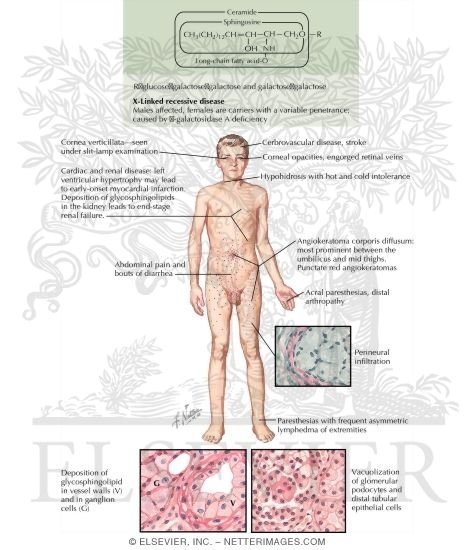 The Sphingolipidoses