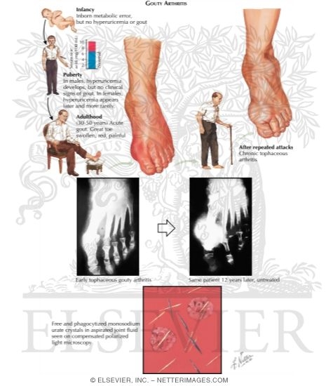 Gouty Arthritis