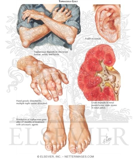Tophaceous Gout
Gouty Arthritis
