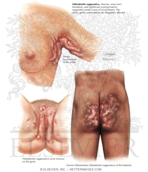 Illustration of Hidradenitis Suppurativa (Acne Inversa) from the Netter Collection