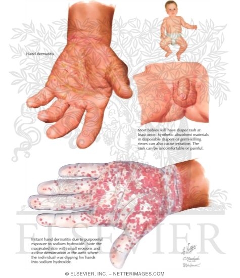 Irritant Contact Dermatitis