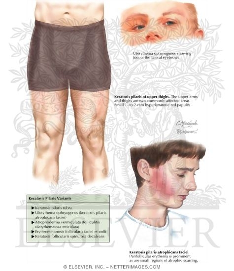 Keratosis Pilaris