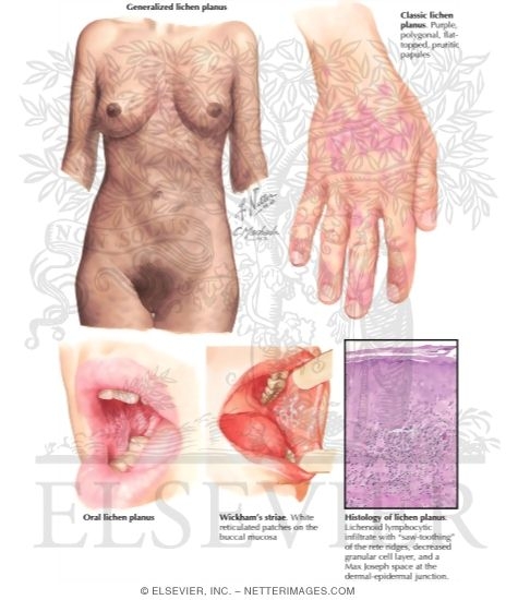 Watermarked preview of labeled image: Lichen Planus