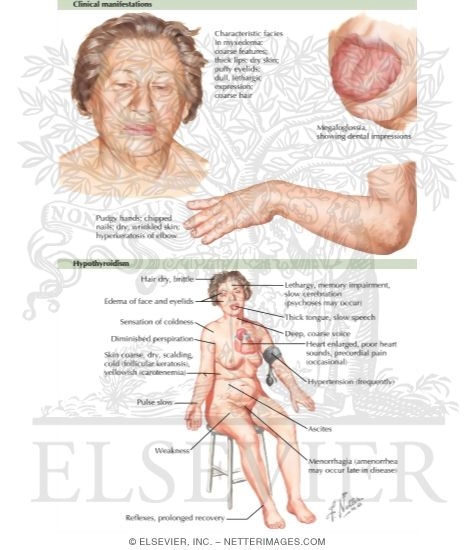 Myxedema